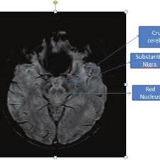 Brainstem location of the brainstem the brainstem is a cns region found in between the spinal cord and the cerebrum it is continuous with the spinal cord. Mri Anatomy Of Deep Brain Stem Nuclei Download Scientific Diagram