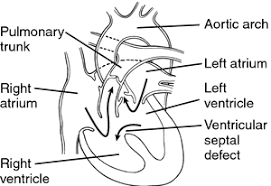 Ventricular Premature Contraction Vpc Definition Of Ventricular Premature Contraction Vpc By Medic Ventricular Septal Defect Medical Dictionary Premature