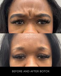 The Latest Advances in Stretch Mark Removal