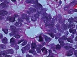 • usually fatal due to meningeal spread, median survival of 9 months. Beginners Guide To Retinoblastoma Medrenaline