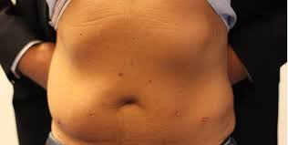 Ereksjon etter prostataoperasjon i, dating norsk online dating. En Pasientreise Til Martiniklinikken Aleris