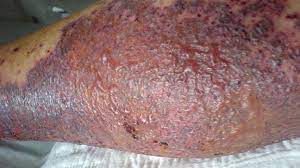 The discolored spots of senile purpura have also been called blood spots or skin hemorrhages. Purpura Causes Diagnosis Treatment And Pictures