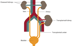 List Of Government Owned Kidney Transplant Centres In Nigeria Including Cost