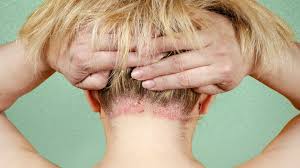 Image result for psoriasis