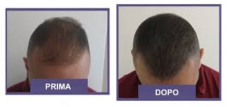 Che cos'è e come funziona? La Tricopigmentazione Cosa E Come Funziona Ecco Tutti Vantaggi