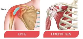 Image result for Rotator Cuff Rupture