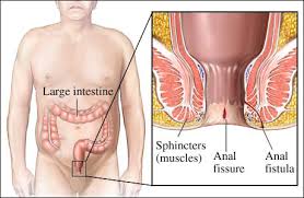 This article will describe the most common causes, treatments, and complications of gastrointestinal fistulae. Anal Fistula Diet And Treatment In Ayurveda Anal Fistula Remedies