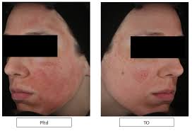 Exosomes, peptides and peri-procedure management