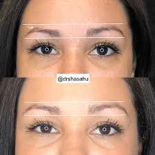 My heavy brow is causing me to look tired and unhappy. Dr Shasa Hu Instant Eyebrow Lift With Pdo Threads Facebook