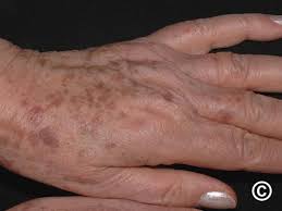 Image result for Solar Lentigo