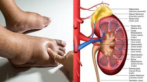 Pin On Kidney Health