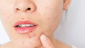Kamu bisa membuat masker tomat sendiri dengan cara menghaluskan 1 buah tomat. Jerawat Pustula Jerawat Nanah Gejala Obat Dll