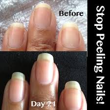 Peeling Nails Becky S Pure Nail Oil Results Peeling Nails Nail Oil Nails