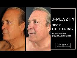 J-Plazty Face and Body Skin Tightening with Renuvion