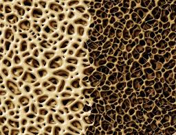 Osteoporosis Vs Osteopenia