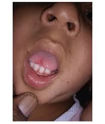 Image result for mouth ulcer on tongue)
