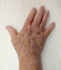Of course, your specialist is the main person whose advice you should follow but it doesn't do anyone harm. Actinic Keratosis Wikipedia