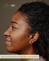 Harnessing the body's natural healing processes, skin boosters promote  sustainable, deep skin rejuvenation. Beauty is not just superficial—it  starts from within. Read the full blog:  https://www.drharishakarpath.com/post/skin-boosters-ballito ...