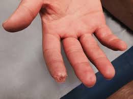 Image result for Systemic Sclerosis