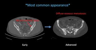 The spread may be very rapid, as in this case, where it took only eight months since … Snmmi 2021 Ct And Mri Appearances Of Benign And Malignant Lesions In Prostate Cancer