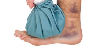 Kulit bisa menjadi biru lebam alias memar, bahkan terjadi di area paha sebagai tanda bahwa seseorang mengalami hemofilia, khususnya pada anak dan balita. Hati Hati Memar Bisa Jadi Gejala Kanker Lho Merdeka Com