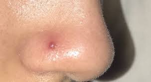 Keloids are scar tissue that result from a hereditary condition. How Do I Get Rid Of A Keloid Caused By A Nose Piercing Photo