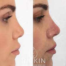 5 Minute Nose Job By Dr Rivkin Nose Job Nonsurgical Nose Job Nose Fillers