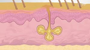 Image result for Sebaceous Gland