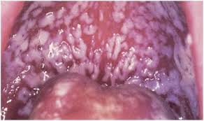 Image result for Candidiasis