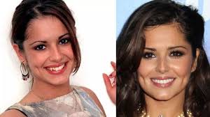 Cheryl Cole Teeth: Before and After