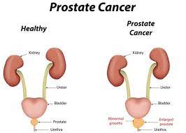 A man's chance of getting cancer is 44% and 23% of men will die from cancer, 38% of women get cancer and 19% die. What Is Prostate Cancer 9 Signs And Symptoms 99 Health Ideas