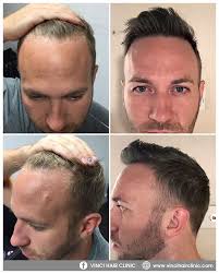 The cost of a hair transplant will be £1,000 to £4,000. Vinci Follicular Unit Extraction Fue Vinci Hair Clinic Hair Loss Men Help Hair Loss Hair Loss