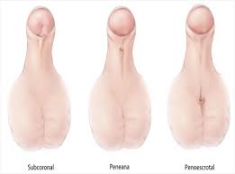 Hipospadias çocukluk yaşta onarılması gereken doğumsal bir anomalidir. Hipospadias Urologia Pediatrica Y De Adulto Urepa