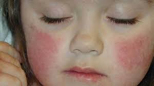 Rash 22 Common Skin Rashes Pictures Causes And Treatment