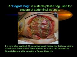 Gal) genitourinary irrigation bag that is sewn to the skin or fascia of the anterior abdominal wall. Acute Peritonitis Online Presentation