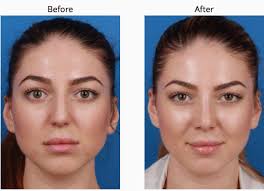 Pin On Nose Jobs Before And After Pictures