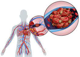 Embolie Pulmonaire : Définition, Symptômes, Traitements | Santé Magazine