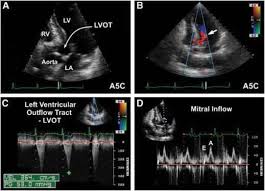 Sep 02, 2016 · stress tests can detect when arteries have 70% or more blockage. Septal Knuckle Hypertrophy Causing Lvot Obstruction Echocardiography Echocardiogram Cardiac Catheterization Linear Relationships