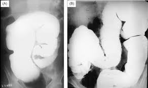 Image result for Megacolon