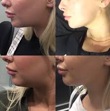 This procedure can be performed by handheld liposuction techniques in the office under just local anesthesia. Chin Lipo Before On The Left And One Week Post Op On The Right Plasticsurgery