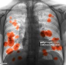 Image result for lung cancer xray