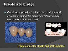 Fixed Prosthodontics Crown Bridge Ppt Video Online Download