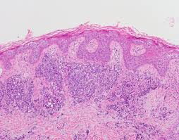 Merkel cell carcinoma of the skin (excluding merkel cell carcinoma of penis, scrotum, and vulva) if you are working with a site/histology that only summary stages and you need to directly code it, please use the seer summary stage 2000 manual Case Of The Week 304
