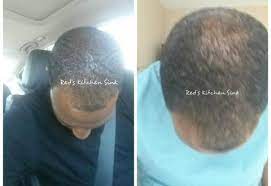 Red's kitchen sink for alopecia. Herbal Hair Systems