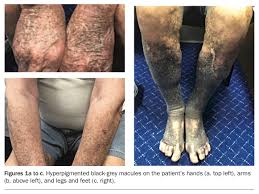 Image result for Diffuse Hyperpigmentation