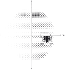 Visual Field Testing From One Medical Student To Another