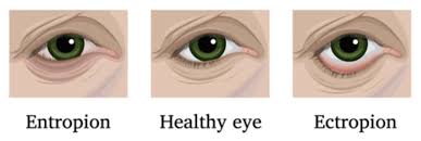 Image result for Entropion