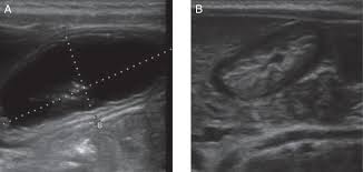 Webmd describes what happens during an ultrasound, what types of ultrasounds are used, and more. Ultrasound Assessment Of The Gastric Contents For The Guidance Of The Anaesthetic Strategy In Infants With Hypertrophic Pyloric Stenosis A Prospective Cohort Study British Journal Of Anaesthesia