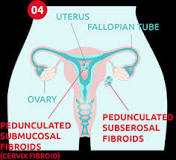 Image result for icd code for fibroids