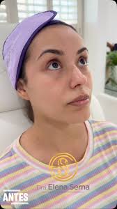 ¿El secreto de una belleza en equilibrio? , Armonización facial  profesional., Hoy les muestro el cambio inmediato y al día siguiente de una  paciente que confió en mis manos para realzar su belleza ...